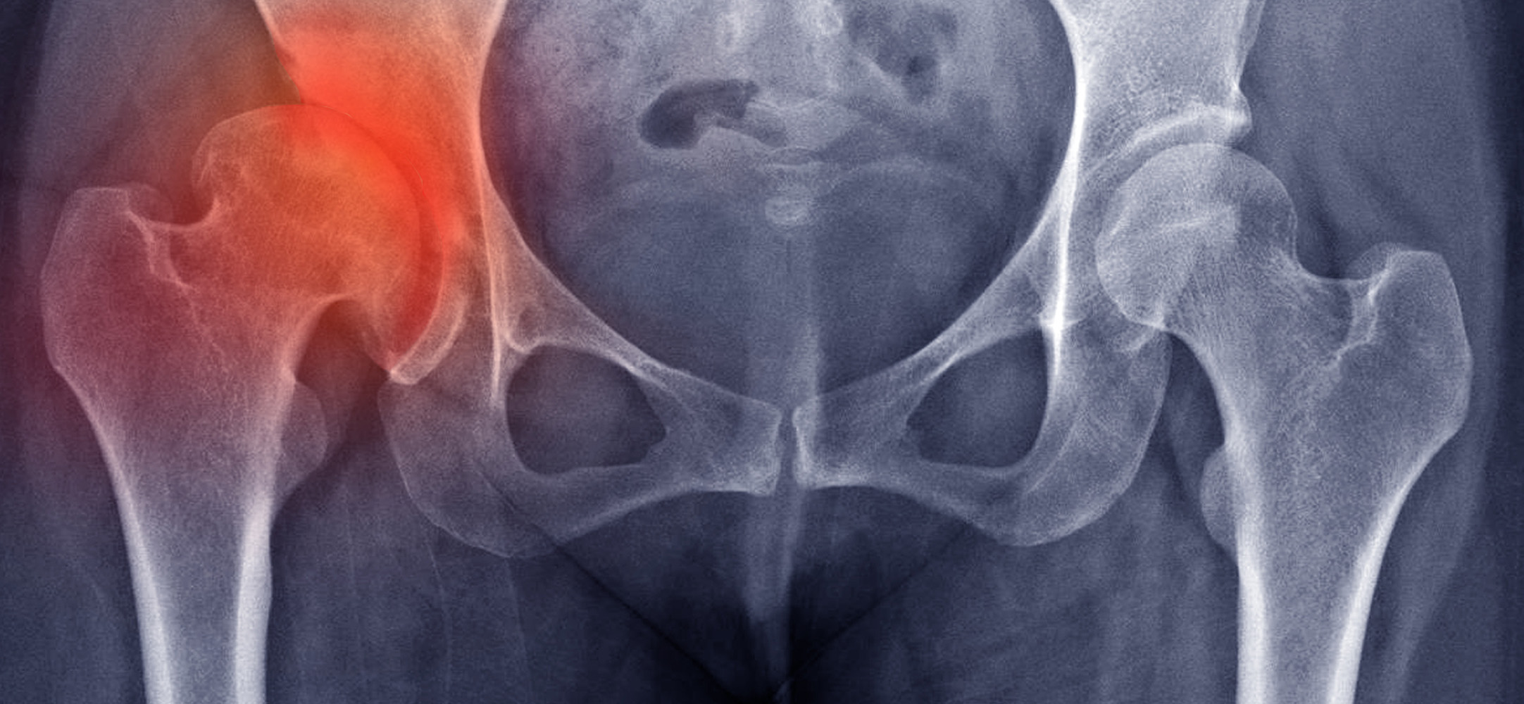 Developmental Hip Dysplasia (Congenital Hip Dislocation)